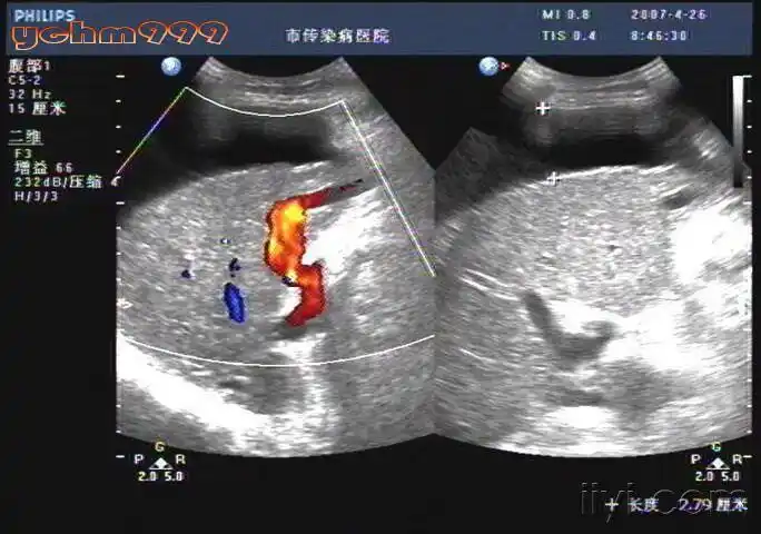 一组肝硬化图片 - 超声医学讨论版 - 爱爱医医学论坛