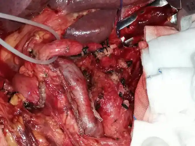 如何做胰腺癌筛查(胰腺癌如何治疗)_百科-涨口碑