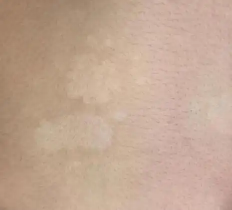 花斑癣的类型与症状特点应当全面认识_花斑糠疹_青岛皮肤病研究院