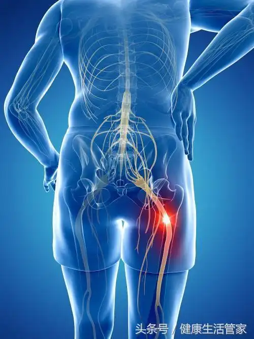 什么是坐骨神经痛!得了坐骨神经痛该怎么治?