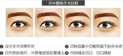 眼角四方开大术_开内眼角和开外眼角