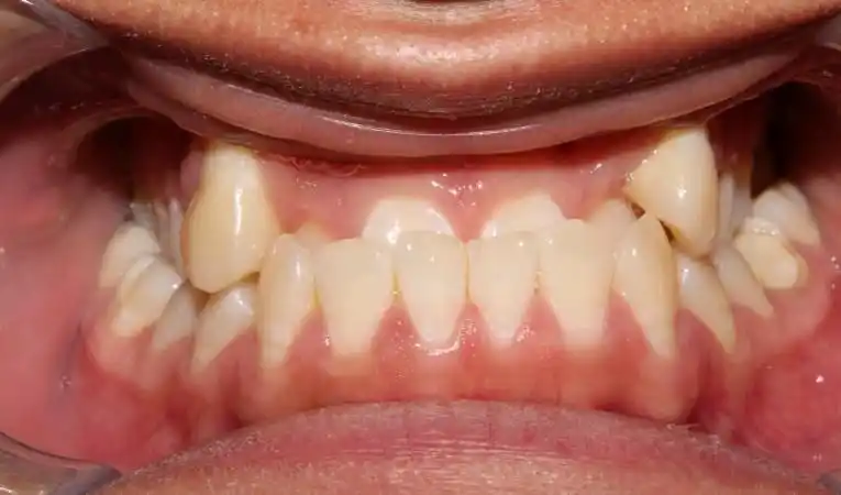 23岁地包天兵哥哥小弘矫正巨变真图