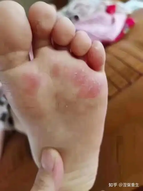 你还以为脚气是遗传给孩子的真实天真