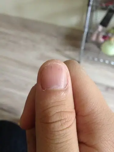 右手大拇指指甲上有黑色竖纹,求原因?