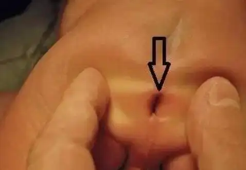 宝宝肛裂图片 (24)_有来医生