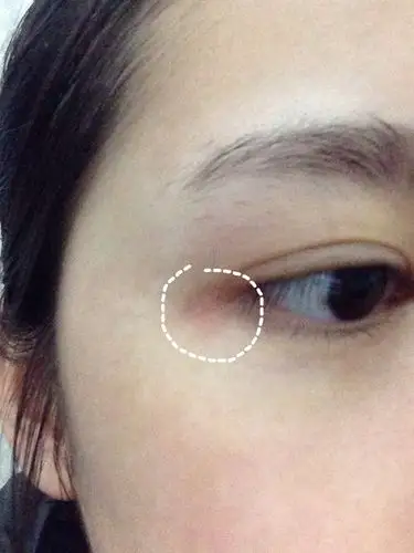 求助!眼角有一小红块,不知道是什么.