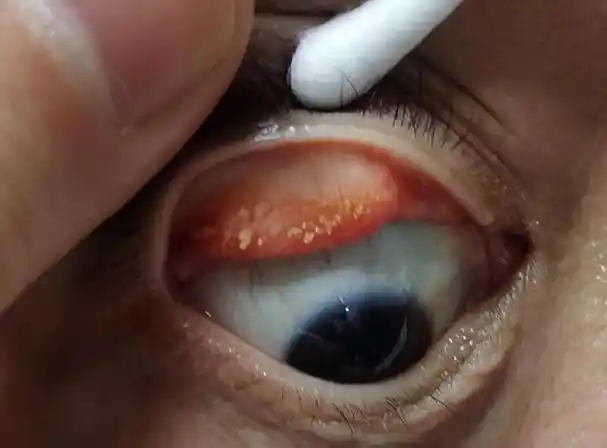 眼睛为什么会长结石呢(眼睛也会长结石吗)(2)