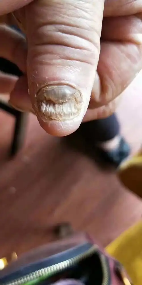 灰指甲特点72157215 16615指甲空 26615指甲增厚 3