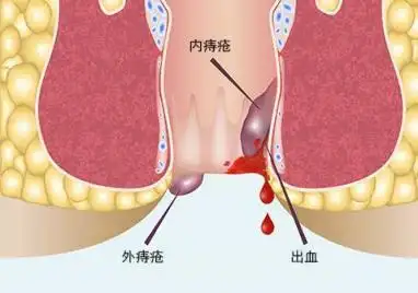 轻微痔疮图片(什么是痔疮)_值得一看_老猫资源网-老猫娱乐网,专注收集