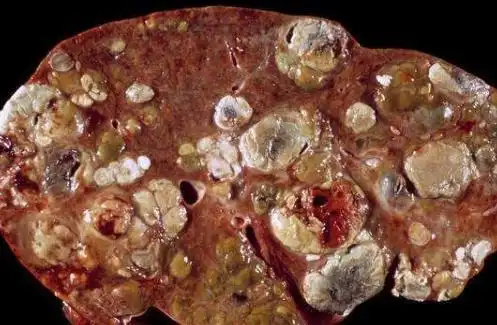 肝硬化是可以治愈的,如果身体出现此个表现,代表身体在逐渐好转