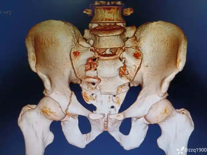 病例分享腰椎骶骨骨折如何处理