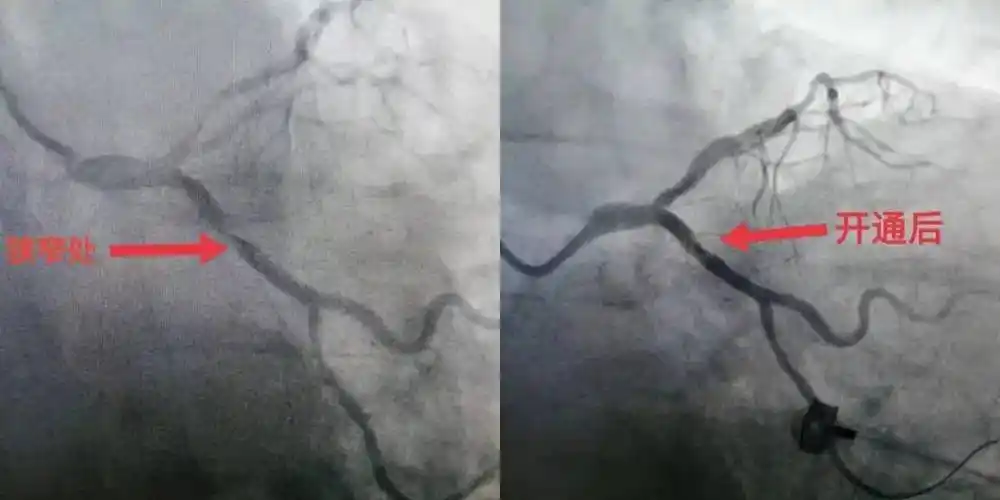 淄博市妇幼保健院心内科顺利开展首例冠脉造影及支架植入术_心脏_患者