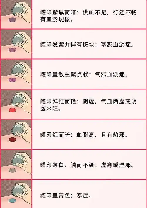 拔罐能排毒吗拔罐后的黑印到底是什么现在知道还不晚