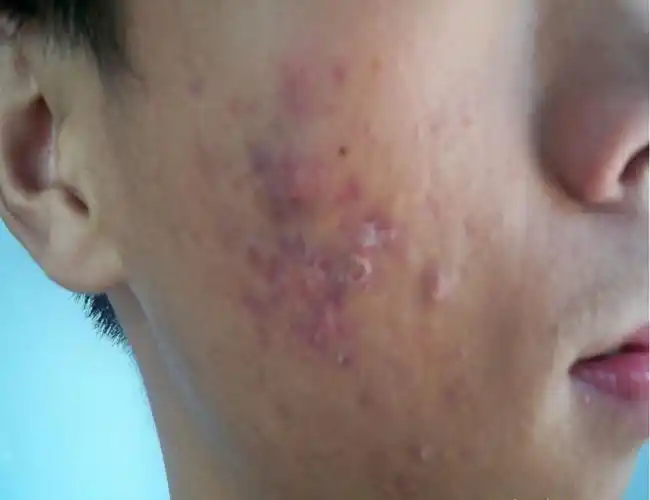 面部有轻度结节痤疮图片