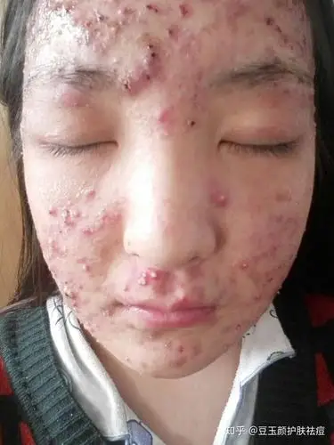 豆玉颜 —— 脸上为什么会长脓包痘痘,长了脓包痘痘应该怎么治?