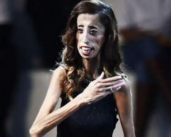 这是一个零脂肪女孩被称是世界上最瘦人之一