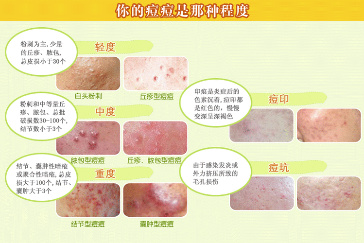 痤疮的分类