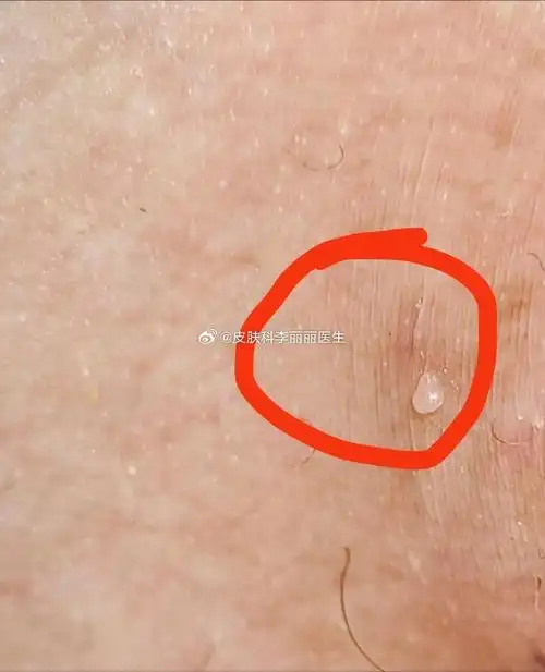 软纤维瘤##健康小知识