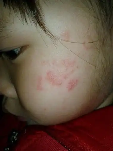 脸上长癣图片 (14)_有来医生