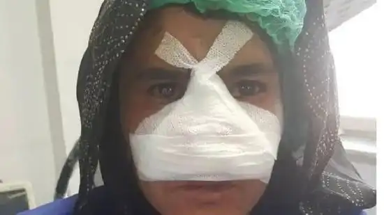 那个被丈夫割掉了鼻子的阿富汗女孩现在还没离婚