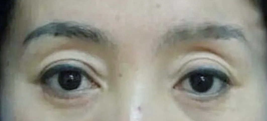 上睑凹陷的成因和矫正方法_眼部整形_眼部整形治疗介绍 - 好大夫在线