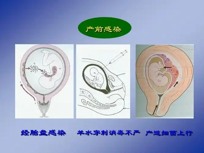 产前感染 经胎盘感染 羊水穿刺消毒不严 产道细菌上行