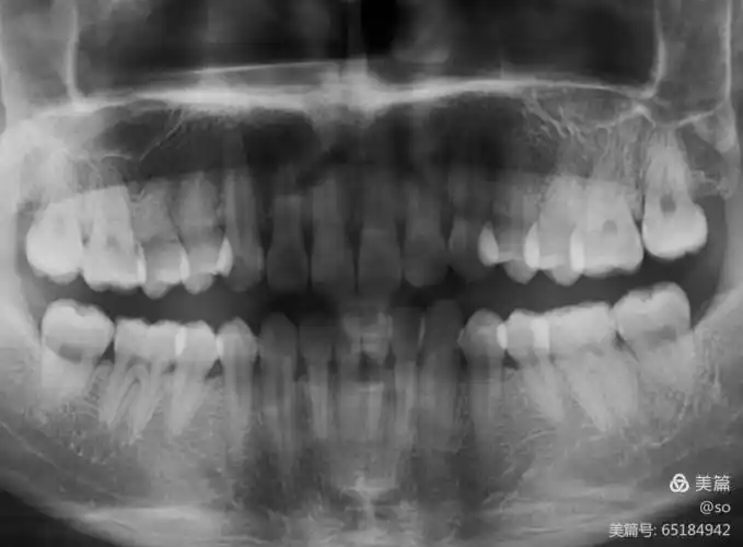 兰小宣口腔洁治报告(德贝登丝特)