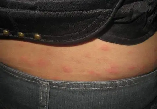 荨麻疹,吃点药真的就行了吗?