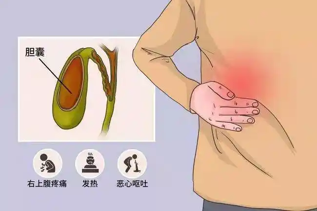 专家回复:结石性胆囊炎,一种是无症状型,一种是有症状型的.