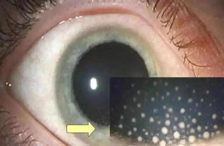 121招飞体检发现的角膜kp通常不合格,如果发现少量角膜色素样kp,病情