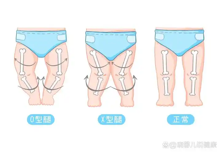 宝宝o型,x型腿如何判断?