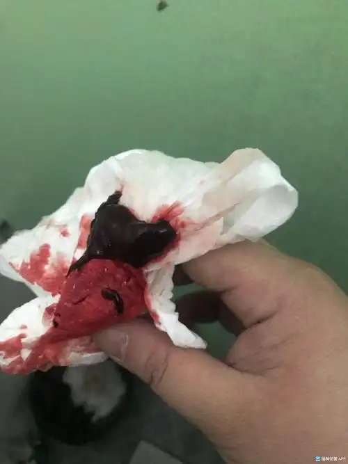 [试管婴儿]十月八号移植的囊胚,到今天23