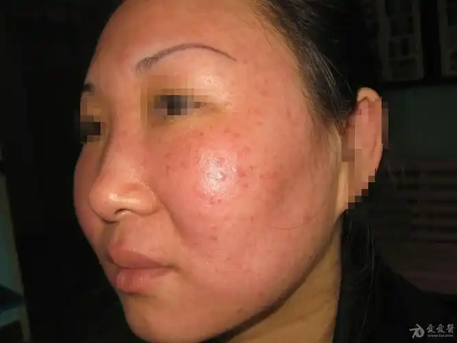 所见最严重的面部蠕型螨皮炎1例