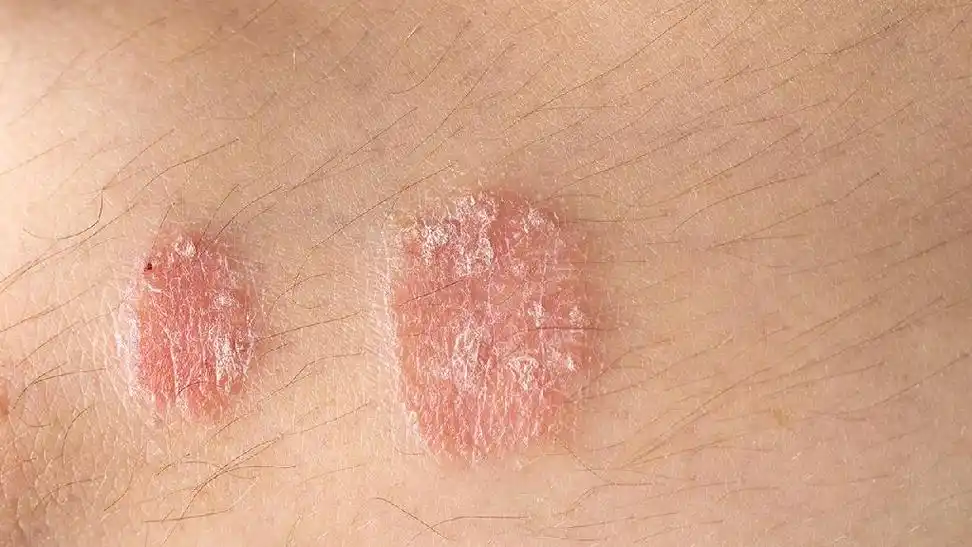 感染梅毒多久后会出现症状感染梅毒会出现哪些症状