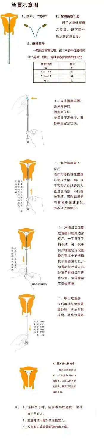 爱母mycu宫内节育器