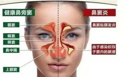 鼻炎是有很多的症状的,一般人们有这样的考虑都是因为身体不舒服才