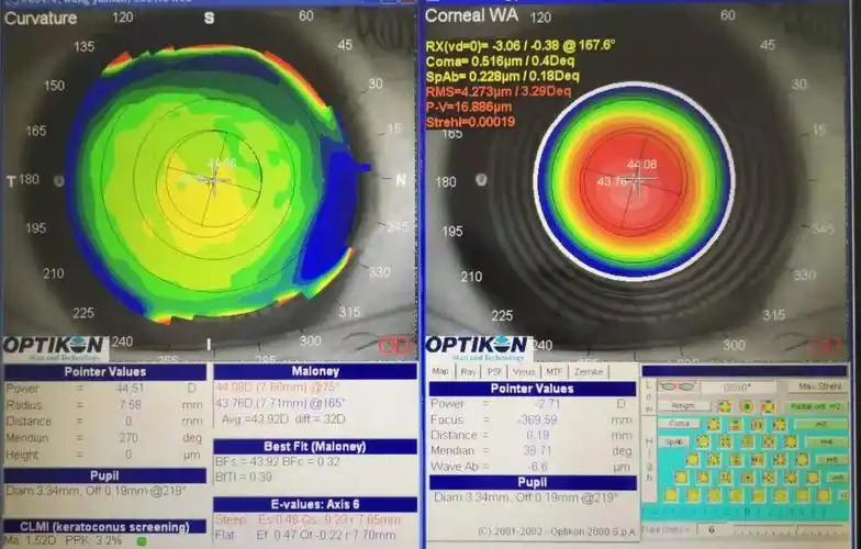 同样是视力10视觉质量却不同青岛眼科医院个性化飞秒激光手术解决难题