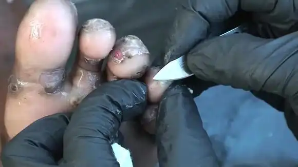 8分钟 小黑脚 沙蚤脚 密集恐惧症慎点-生活视频-搜狐视频