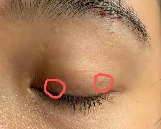 请问眼皮上这个是疣吗