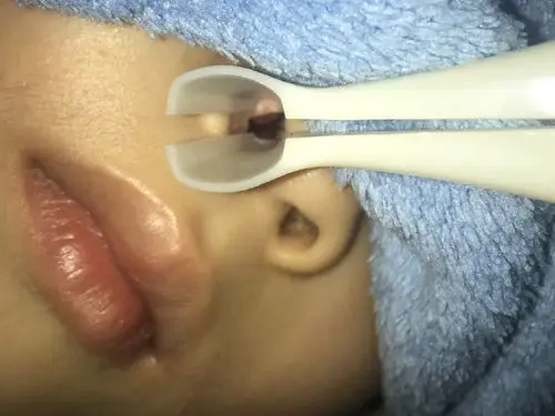 没肿是这样的,鼻甲很小.