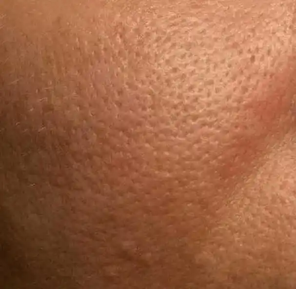 缺水型毛孔粗大形成原因:皮肤干燥缺水状况表现:肌肤缺水,毛孔就如