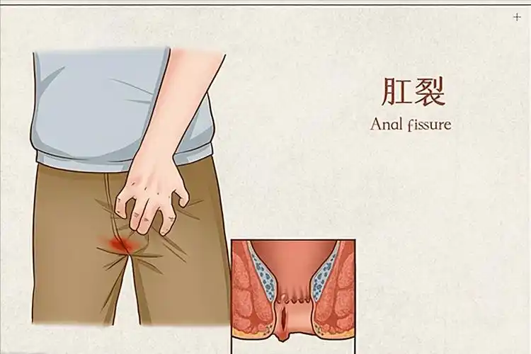 中年男性患上肛门癌,肛门癌早期症状,这几个信号不可忽视!