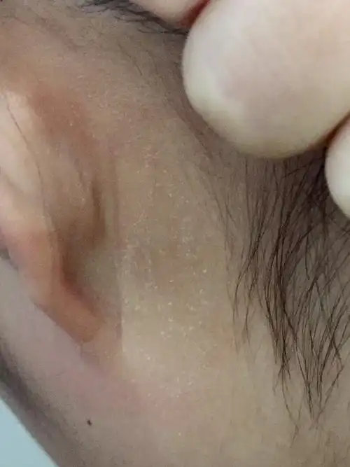 两三个星期了,耳朵后面起皮,还很痒,是怎么回事?