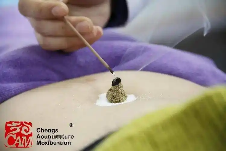 神阙穴艾灸:赶走慢性腹泻