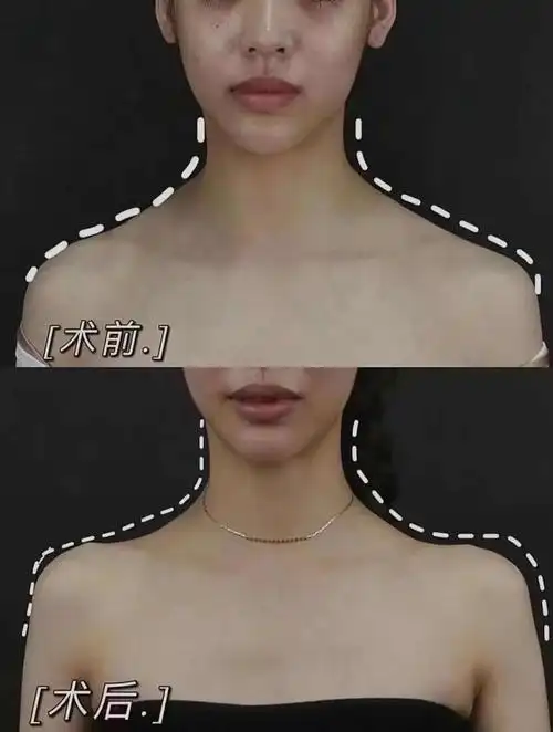 出于安全和效果的考虑,跟大家叮嘱治疗后的注意事项: 1.