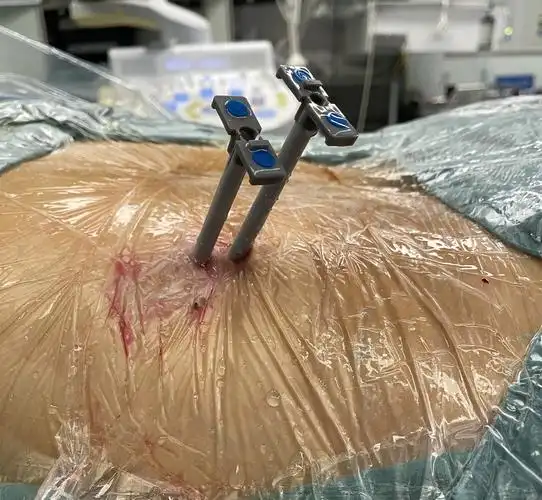 有些肾结石分散在肾盂,前后组盏,往往需要多通道碎石治疗大型三甲医院