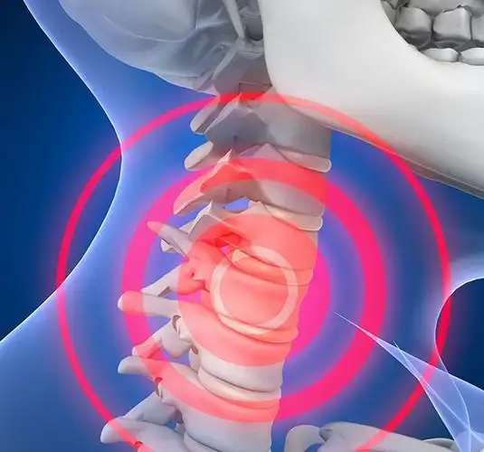 空军总医院顾建文谈椎动脉型颈椎病