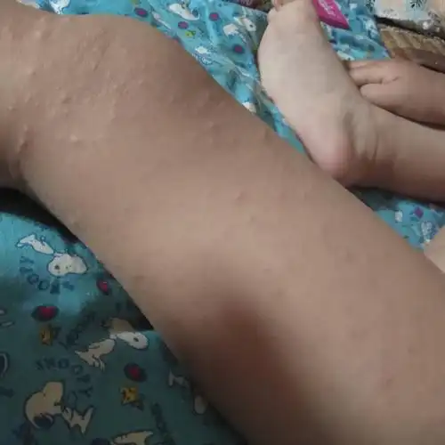 孩子最近得了疱疹,身上起了很多,大约什么时候好呢