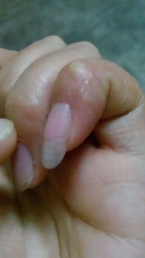 手指上有小水泡是怎么回事 夏天手指上有小水泡是怎么回事