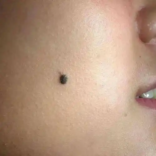 身上的痣会变成黑色素瘤吗?